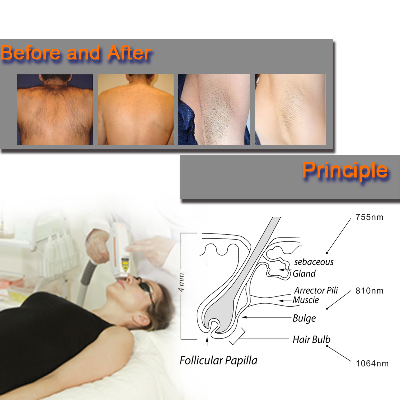 810 диодный лазер1