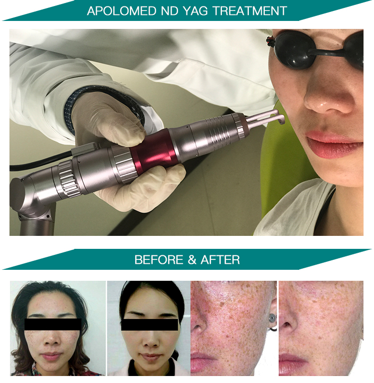 HS-298 фото до и после