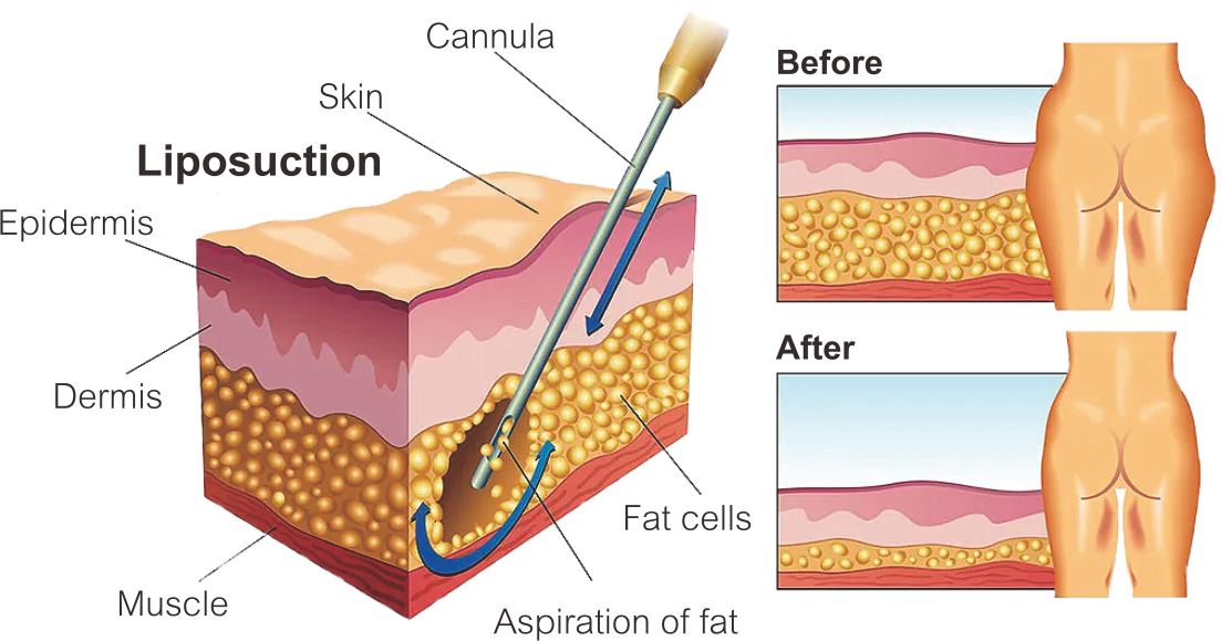Насадка для лазерного липолиза 