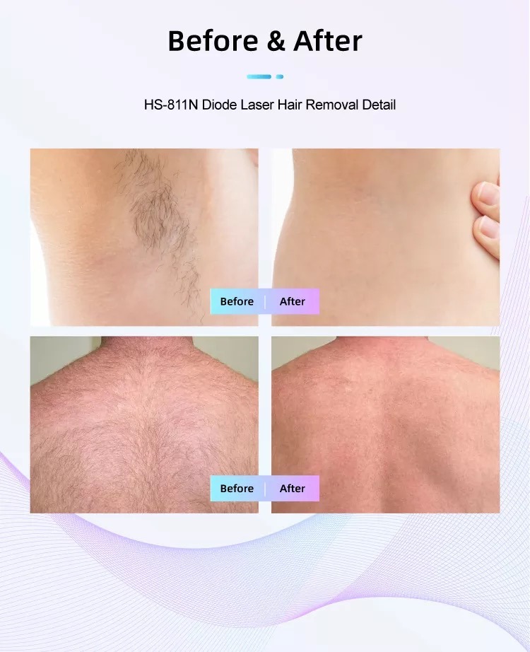 Завод по производству диодных лазерных машин для удаления волос HS-811