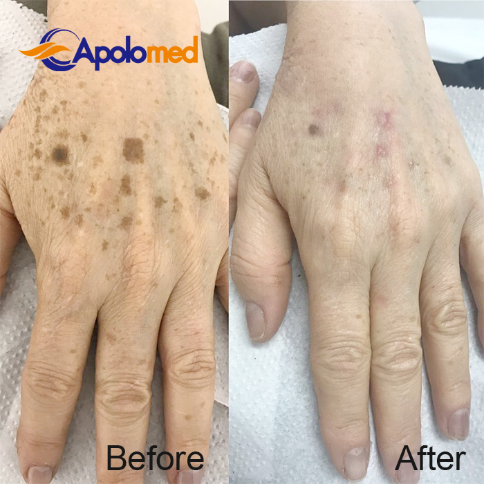 Лазерная установка Q-Swithced Nd YAG до после