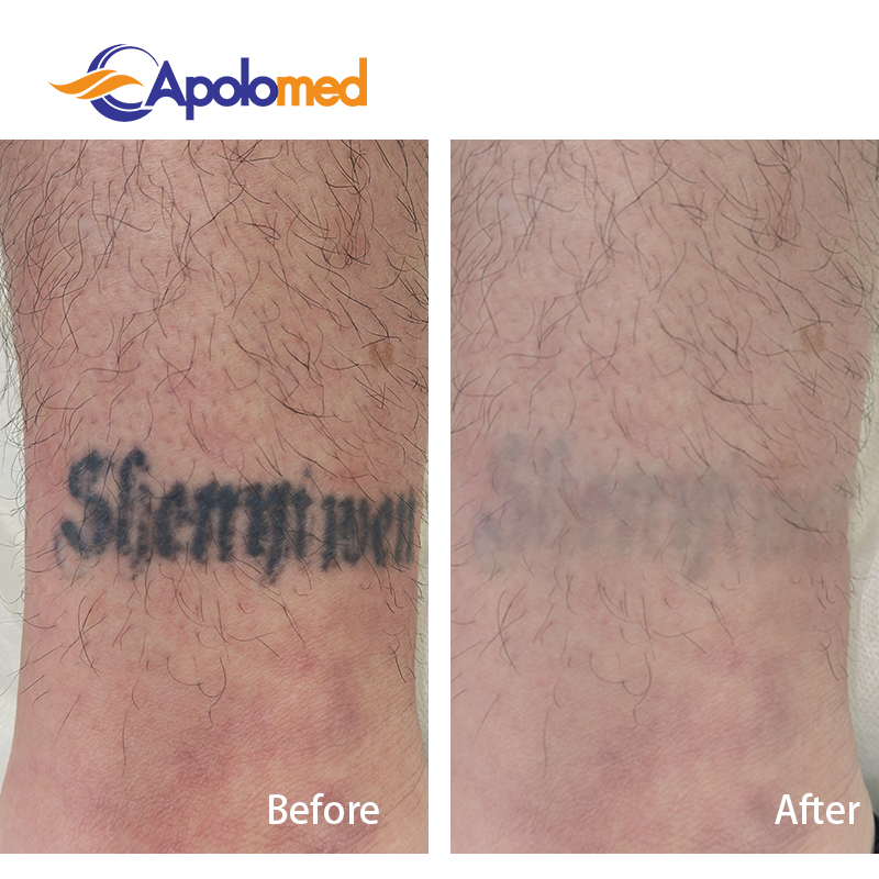 Время простоя лазерного удаления татуировок: чего ожидать после каждого сеанса