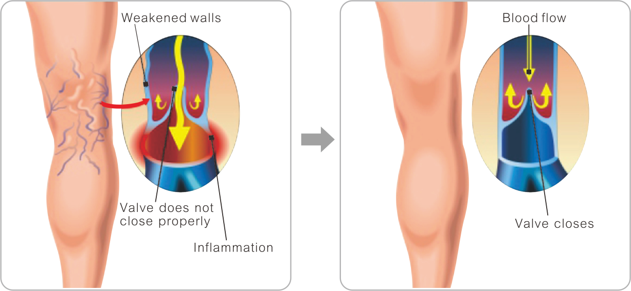 Варикозное расширение вен