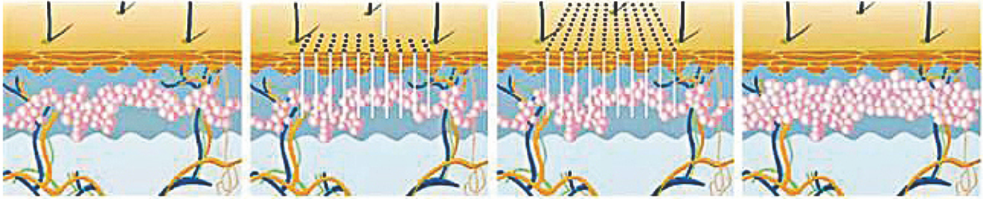 Эрбиевый волоконный лазер 1550 нм ---- Глубокое ремоделирование